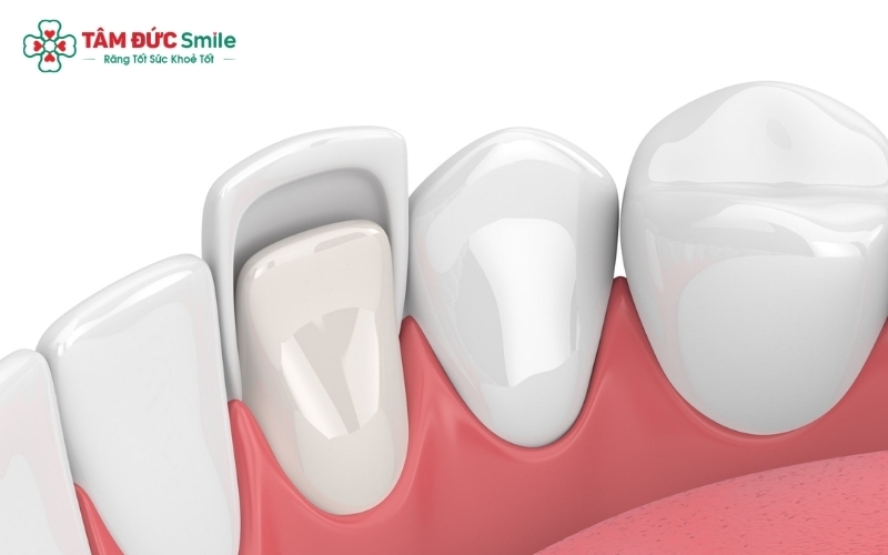 Sự khác biệt lớn nhất veneer với bọc sứ nằm ở mức độ can thiệp vào cấu trúc răng thật. 