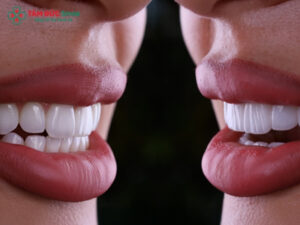 Nên dán sứ Veneer hay bọc răng sứ? So sánh chi tiết