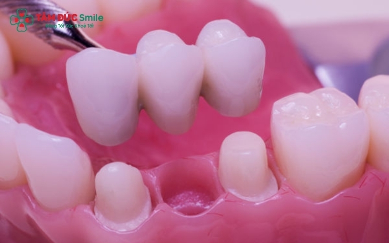 Không có phương pháp nào tốt nhất, chỉ có phương pháp phù hợp nhất với tình trạng răng của bạn