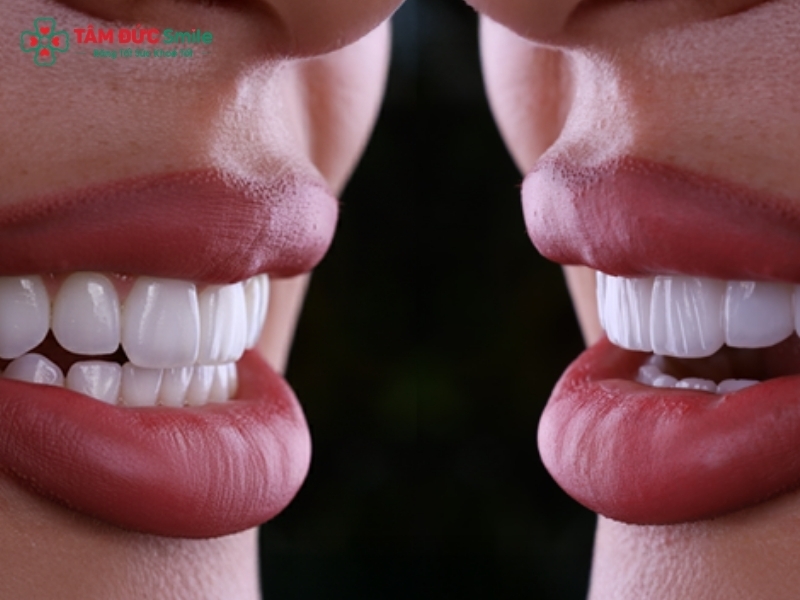 Nên dán sứ Veneer hay bọc răng sứ? So sánh chi tiết