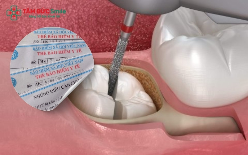 Việc quyết định có nên nhổ răng khôn hay không cần dựa trên kết quả thăm khám lâm sàng và hình ảnh X-quang để đánh giá chính xác hướng mọc.