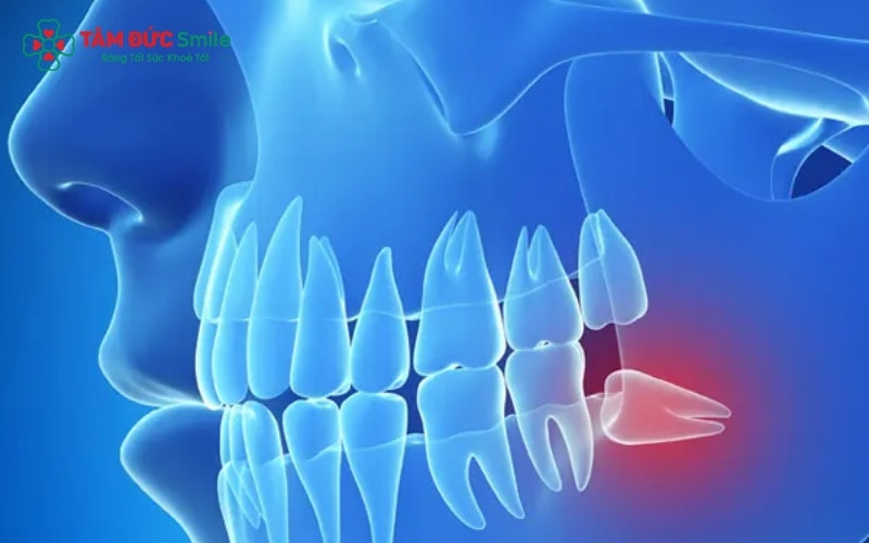 Răng khôn mọc lệch đâm vào răng số 7 là trường hợp điển hình cần nhổ bỏ sớm để tránh biến chứng sâu răng và hỏng chân răng kế cận.