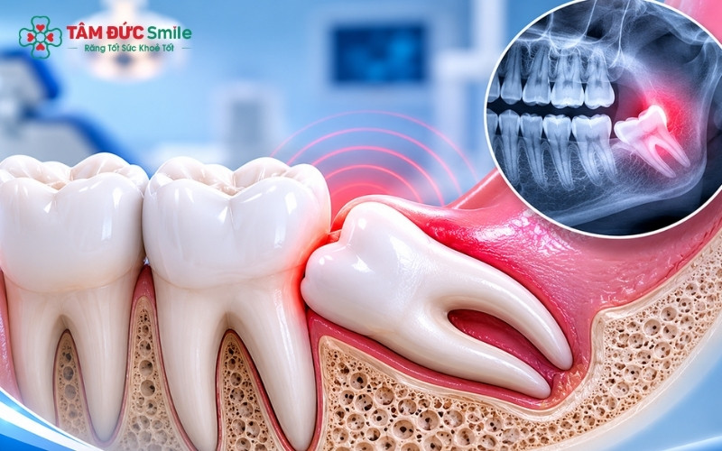 Tại Nha khoa Tâm Đức Smile, nhổ răng khôn bằng công nghệ Piezotome giúp hạn chế sang chấn, giảm sưng đau và giúp vết thương nhanh lành.