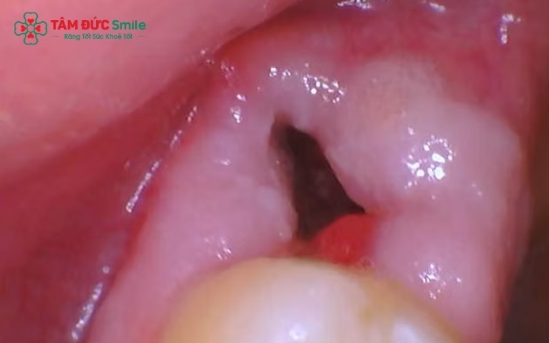 Nhổ răng khôn bao lâu thì lành? Hiểu rõ các giai đoạn hồi phục giúp bạn chủ động hơn trong việc chăm sóc sức khỏe