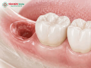 Nhổ răng số 8 bao lâu thì lành? Thời gian hồi phục và cách chăm sóc