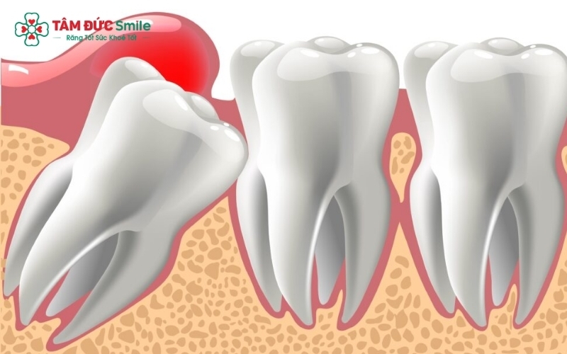 Những trường hợp răng khôn mọc lệch, mọc ngang hoặc có chân răng phức tạp thường cần can thiệp sâu hơn vào mô nướu và xương, đây là nguyên nhân chính dẫn đến cảm giác sưng đau