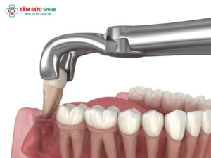 Nhổ răng khôn có đau không? Bao lâu hết đau và cách giảm đau hiệu quả