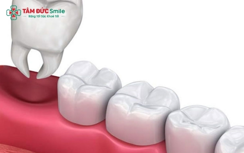 Việc kiểm tra lâm sàng sau khi nhổ răng số 8 giúp bác sĩ xác định cơn đau ở răng số 7 là phản ứng bình thường hay là dấu hiệu của bệnh lý cần can thiệp.