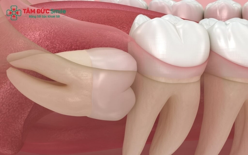 Răng số 8 mọc lệch, mọc ngang đâm vào răng số 7 là nguyên nhân phổ biến gây sâu mặt xa hoặc viêm quanh răng kế cận, dẫn đến cảm giác đau nhức sau khi nhổ