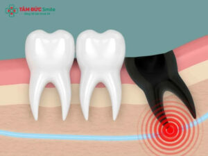 Nhổ răng số 8 đau răng số 7 có sao không? Nguyên nhân và cách xử lý