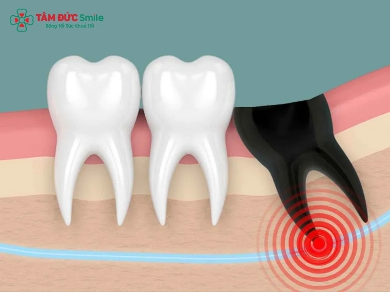 Nhổ răng số 8 đau răng số 7 có sao không? Nguyên nhân và cách xử lý