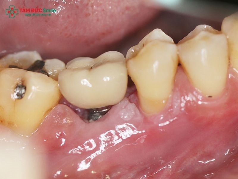 Trụ Implant có thể bị đào thải khi không tích hợp tốt với xương hàm.