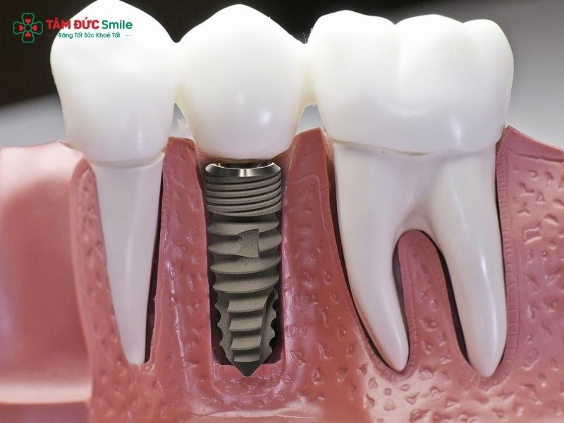Bác sĩ thực hiện tiểu phẫu đặt trụ Implant vào xương hàm theo kế hoạch điều trị.