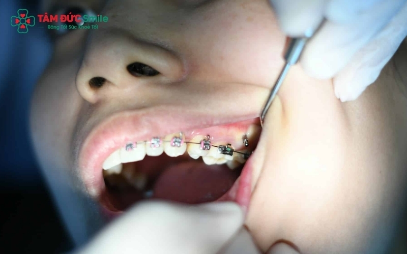 Sâu răng giai đoạn đầu khi niềng thường chỉ là những đốm trắng mất khoáng quanh mắc cài