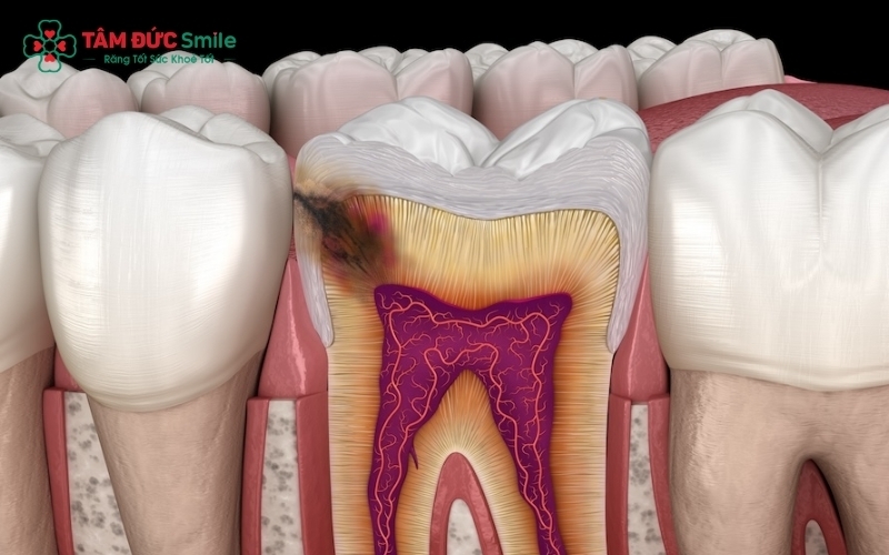 Sâu răng khi niềng nếu không xử lý kịp thời sẽ tiến triển nhanh, gây đau nhức, viêm nướu và có thể làm kéo dài thời gian niềng răng do phải tạm dừng để điều trị tủy