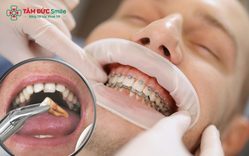 Nong hàm hoặc mài kẽ răng là những phương pháp hiện đại giúp tạo thêm khoảng trống mà không cần phải nhổ răng thật.