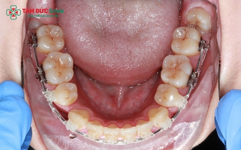 Việc có cần nhổ răng hay không phụ thuộc vào tình trạng khớp cắn và khoảng trống cần thiết để sắp xếp răng của mỗi người.