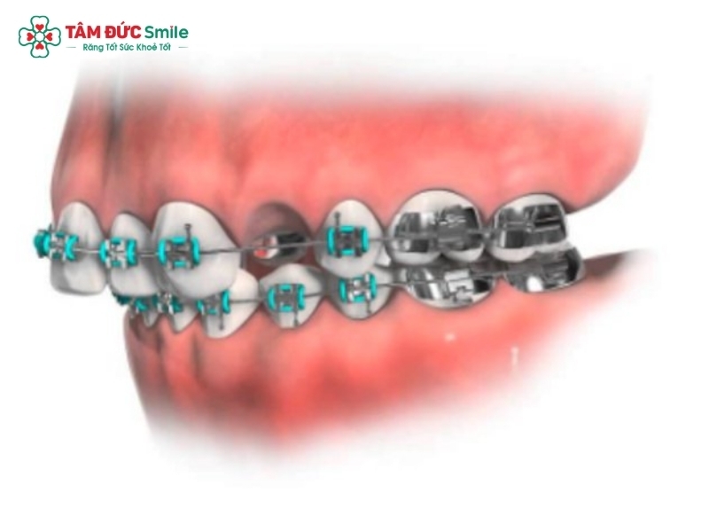 Niềng răng có cần nhổ răng không?