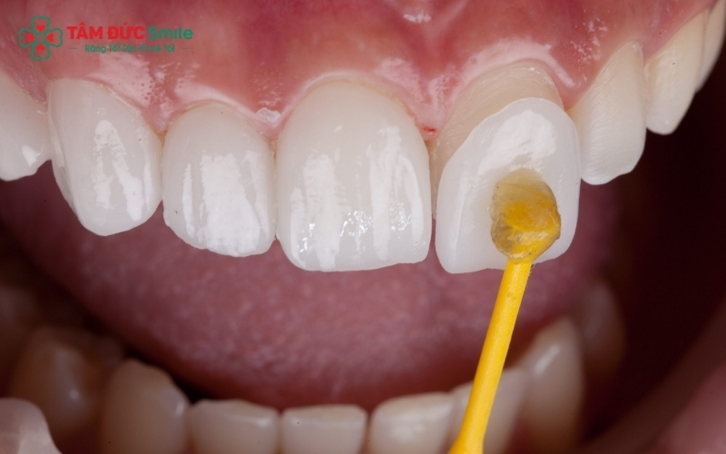 Quy trình chuẩn y khoa đảm bảo mặt dán Veneer khít sát tuyệt đối, bảo tồn tối đa răng thật và mang lại nụ cười thẩm mỹ, khỏe mạnh bền lâu.