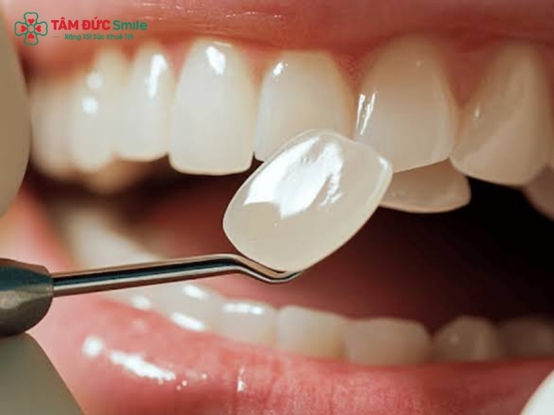 Quy Trình Dán Sứ Veneer Chuẩn Y Khoa