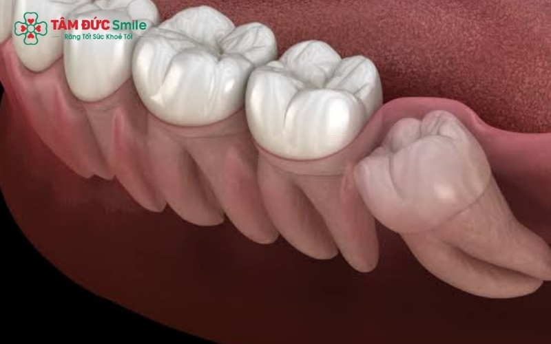 Vị trí răng khôn mọc lệch, mọc ngang hoặc mọc ngầm để đưa ra chỉ định nhổ răng kịp thời, bảo vệ răng số 7 kế cận