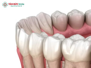 Răng là gì? Cấu tạo, phân loại, chức năng và cách chăm sóc răng khỏe