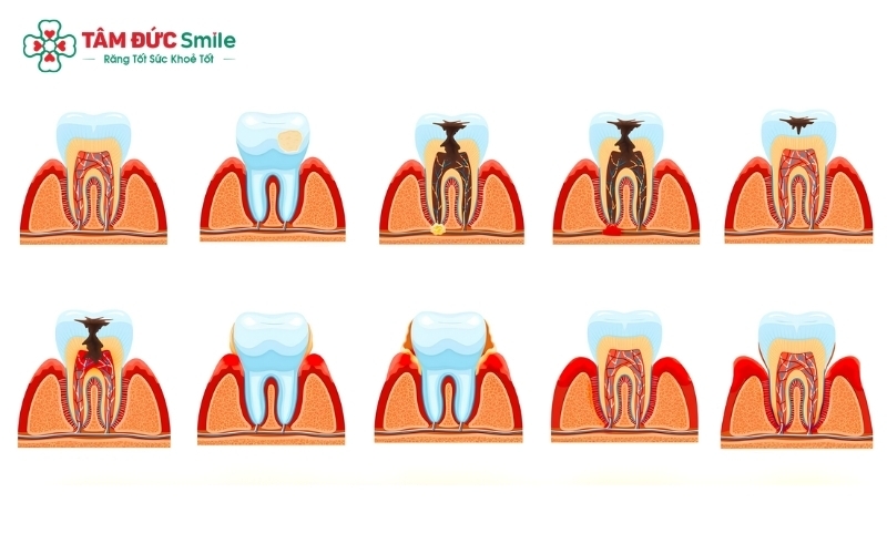 Các bệnh lý răng miệng như sâu răng hay viêm tủy nếu không được phát hiện và điều trị kịp thời sẽ gây ảnh hưởng nghiêm trọng đến sức khỏe răng thật.