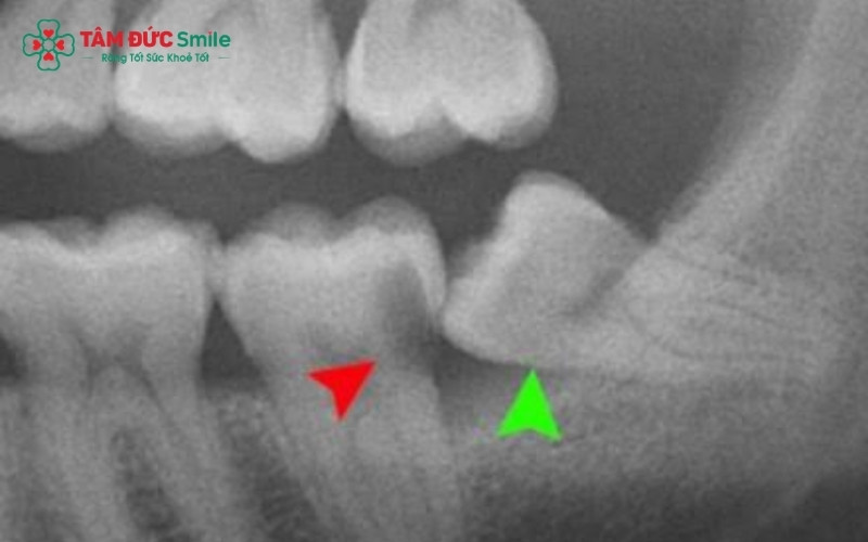 Hình ảnh X-quang cho thấy cung hàm không đủ khoảng trống là nguyên nhân chính khiến răng khôn mọc nghiêng hoặc mọc ngầm dưới nướu.
