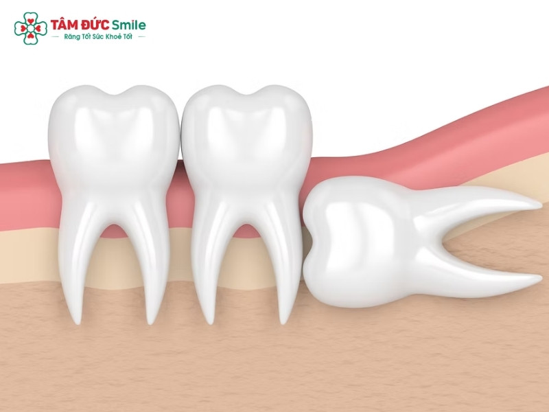 Răng khôn mọc nghiêng có nguy hiểm không?