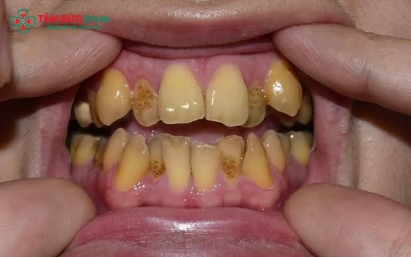 Các dấu hiệu của nhiễm fluor rất đa dạng, từ những vệt trắng mờ đến các tổn thương cấu trúc men răng nặng gây đổi màu vàng nâu sẫm.