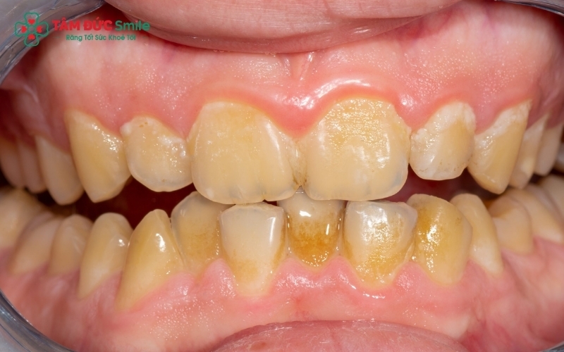 Răng ố vàng không chỉ là vấn đề thẩm mỹ khiến bạn thiếu tự tin, mà còn có thể là dấu hiệu của mảng bám cao răng cần được làm sạch để bảo vệ sức khỏe nướu.