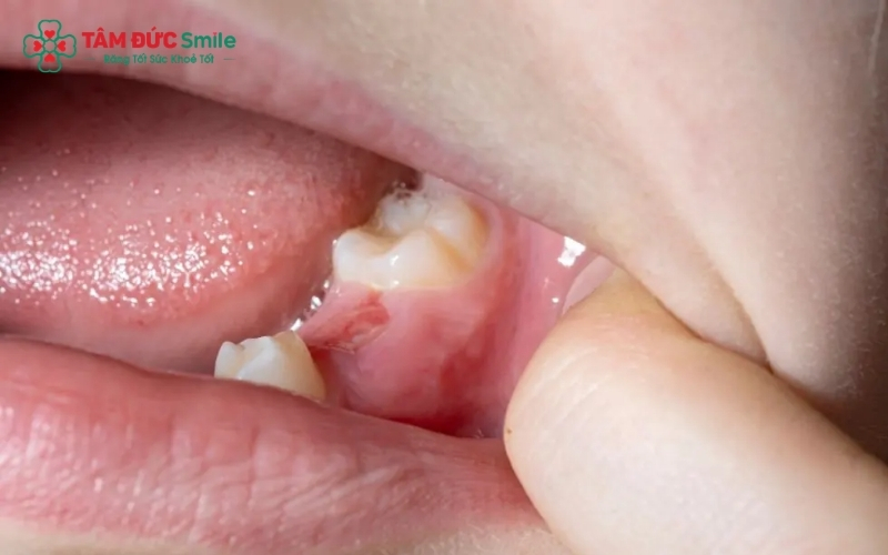 Trì hoãn điều trị khi răng số 7 đã bị sâu khiến vi khuẩn tiến sâu vào tủy, gây đau nhức dữ dội và có nguy cơ làm ảnh hưởng đến các răng lân cận.