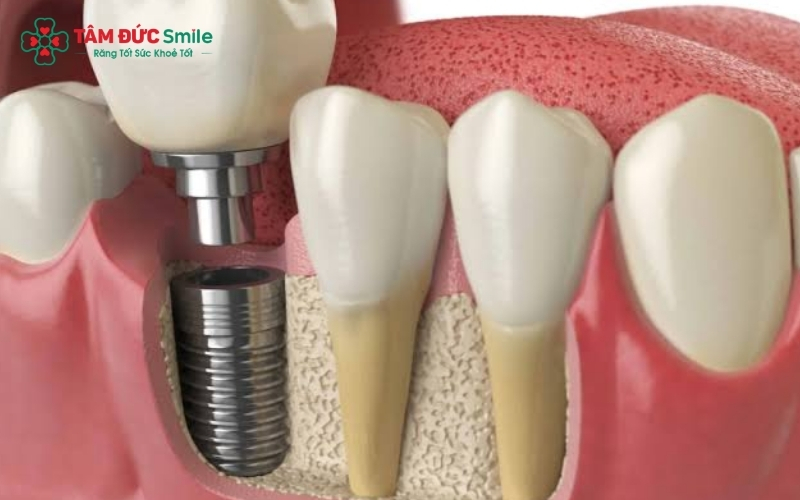 Răng số 7 đóng vai trò cực kỳ quan trọng trong việc nghiền nát thức ăn, trồng răng Implant là giải pháp tối ưu nhất để khôi phục chức năng