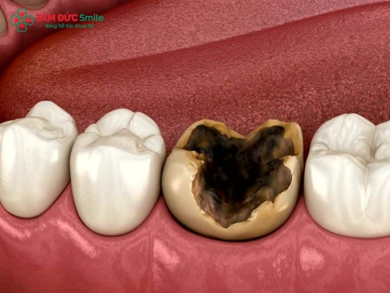 Răng số 7 bị sâu có nên nhổ không? Răng số 7 bị sâu không nhổ có sao không?