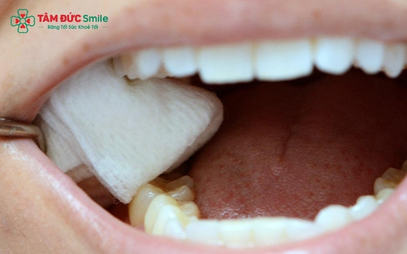 Cắn gạc đúng cách sau khi nhổ răng khôn giúp co mạch, giảm sưng và xoa dịu cảm giác đau nhức hiệu quả.