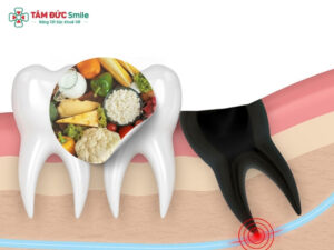 Sau khi nhổ răng khôn nên làm gì? Cách chăm sóc để nhanh lành, ít đau