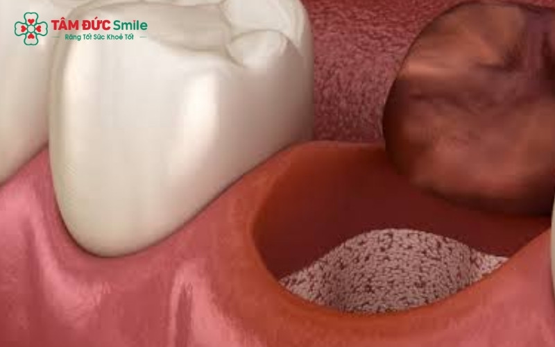 Tuyệt đối không sử dụng ống hút hoặc hút thuốc lá vì lực hút và hóa chất có thể làm bong cục máu đông, dẫn đến biến chứng viêm ổ răng khô.