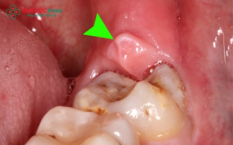 Sưng lợi răng số 8 là tình trạng nướu quanh răng khôn bị đỏ, căng tức do răng đang mọc hoặc do vi khuẩn tích tụ gây viêm nhiễm