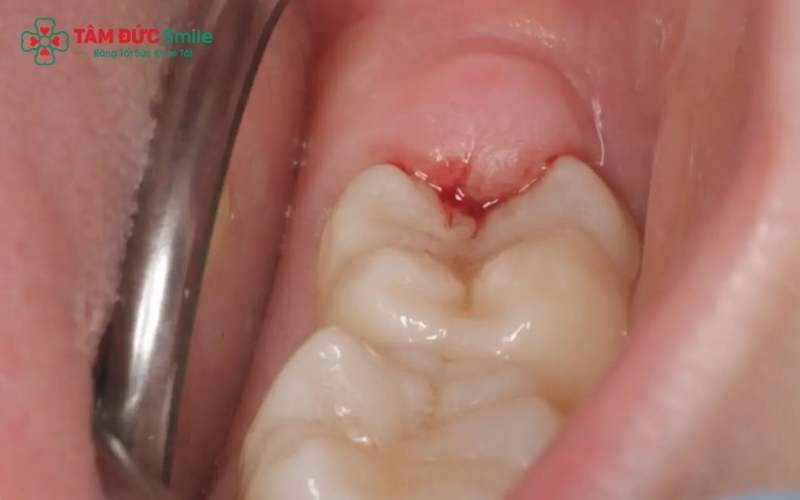 Các dấu hiệu sưng lợi răng khôn điển hình bao gồm nướu đỏ thẫm, cảm giác đau âm ỉ lan sang vùng tai, khó há miệng và hơi thở có mùi khó chịu