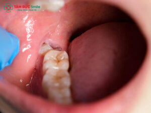 Sưng lợi răng số 8: Dấu hiệu, nguyên nhân, cách điều trị hiệu quả