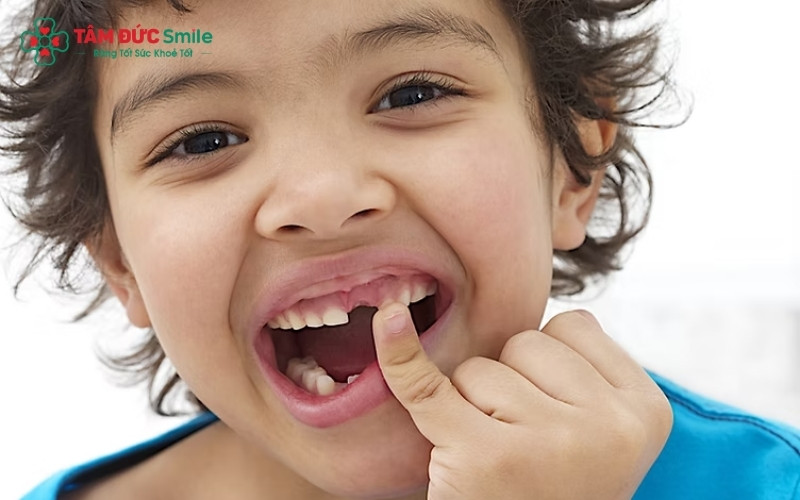 Răng sữa lung lay là dấu hiệu tự nhiên cho thấy chân răng đang tiêu dần để nhường chỗ cho răng vĩnh viễn sẵn sàng mọc lên.