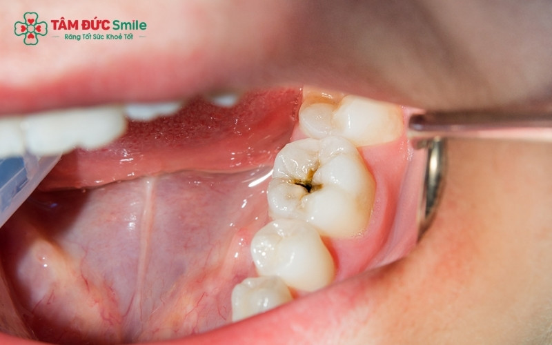  Mức độ ê buốt khi trám răng phụ thuộc vào độ sâu của lỗ sâu; tổn thương càng gần tủy thì răng càng trở nên nhạy cảm hơn.