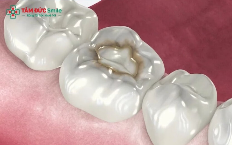 Trám răng là giải pháp tối ưu để phục hồi hình dáng và chức năng cho các trường hợp răng sâu, mẻ, vỡ hoặc mòn cổ răng.