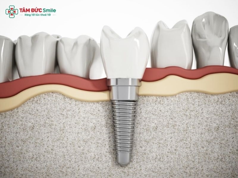 Tái khám định kỳ giúp bác sĩ kiểm tra mão sứ, vít kết nối và độ ổn định của trụ Implant để xử lý kịp thời khi có bất thường.