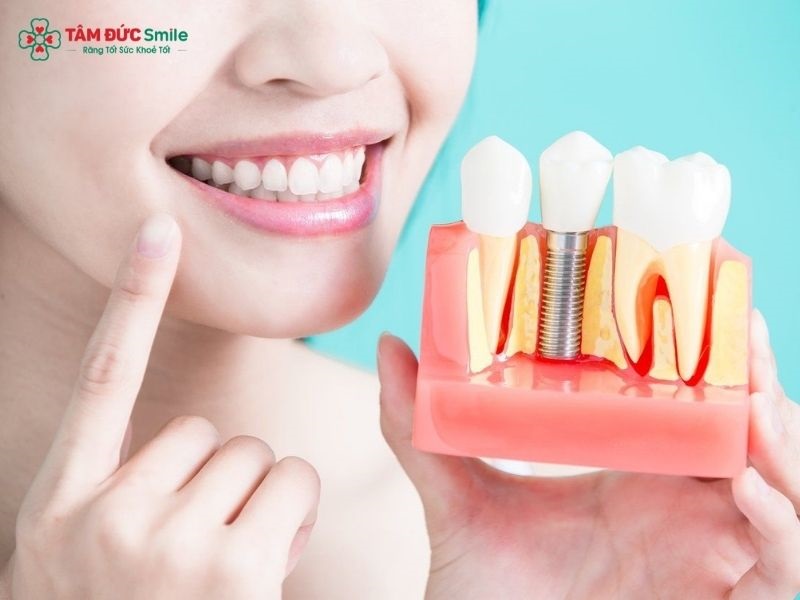 Vệ sinh kỹ vùng quanh Implant bằng bàn chải mềm, chỉ nha khoa hoặc máy tăm nước giúp hạn chế mảng bám và viêm quanh trụ.