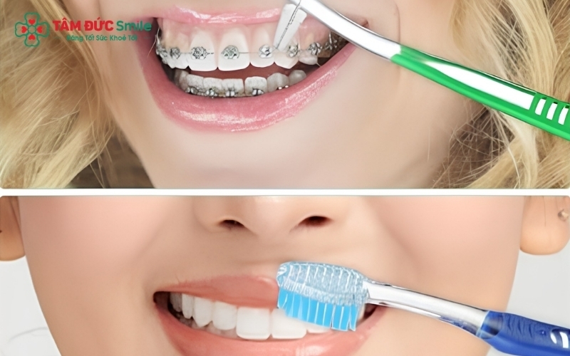 Sự kết hợp giữa bàn chải chuyên dụng, bàn chải kẽ và bàn chải điện là "bộ tứ" hoàn hảo để duy trì sức khỏe răng miệng trong suốt hành trình niềng răng.