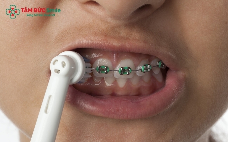 Kỹ thuật chải răng nghiêng 45 độ giúp lông bàn chải tiếp cận sâu vào vùng nướu và các khe mắc cài, loại bỏ triệt để mảng bám tích tụ.