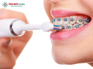 Bàn chải cho người niềng răng: Cách chọn đúng, vệ sinh mắc cài hiệu quả