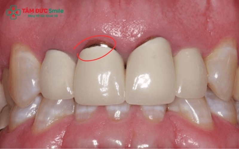 Răng sứ kim loại bị oxy hóa là nguyên nhân hàng đầu gây tình trạng đen viền nướu sau một thời gian sử dụng.