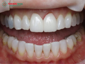 Bọc răng sứ bị đen nướu: Nguyên nhân, dấu hiệu và cách khắc phục